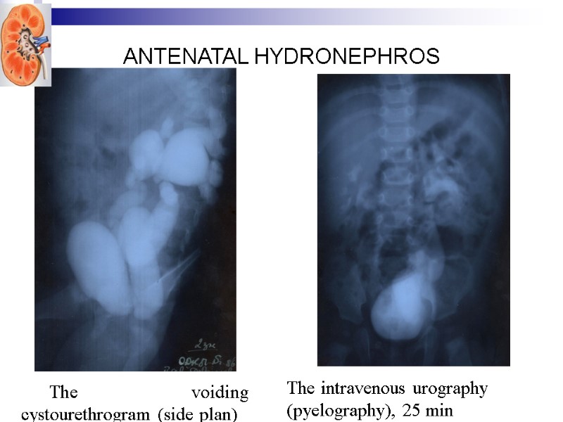 ANTENATAL HYDRONEPHROS  The voiding cystourethrogram (side plan) The intravenous urography (pyelography), 25 min